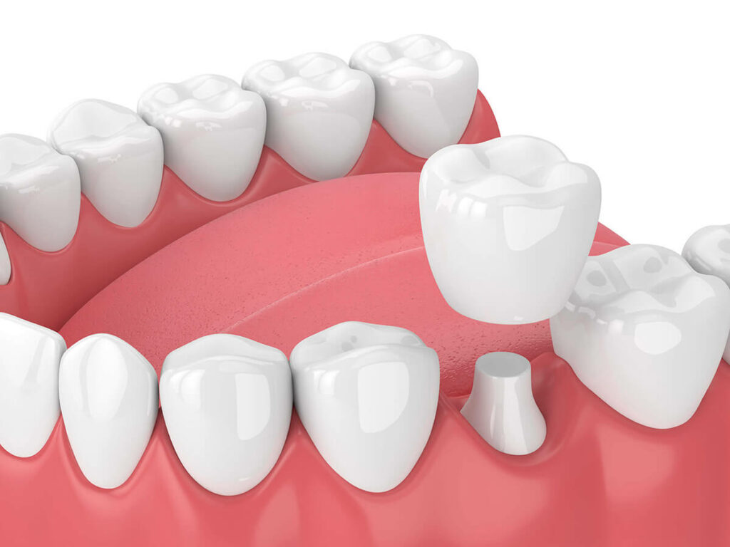 3D illustration of a lower jaw with dental crowns and a bridge, depicting a dental restoration process with one tooth prepared for crown placement, set against a white and pink background