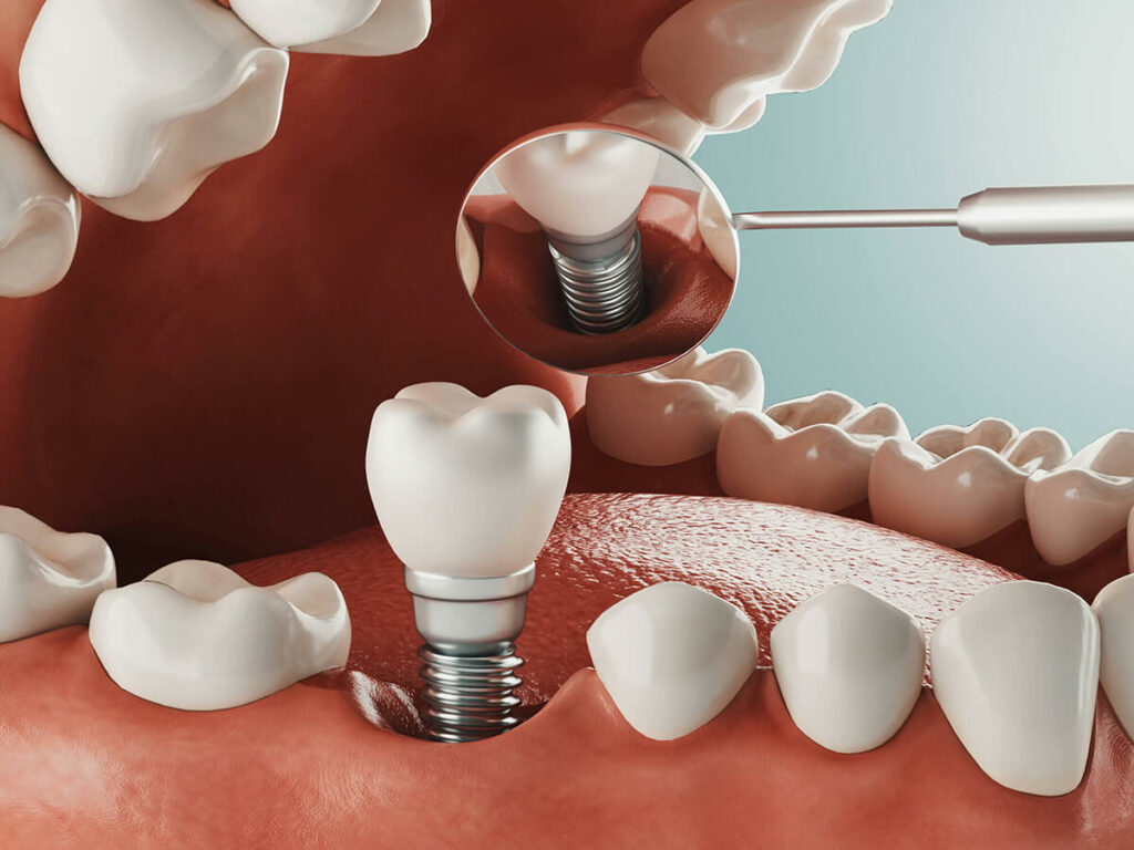 Detailed 3D rendering of a dental implant procedure on a lower jaw showing an implant post in the bone with an abutment and a crown, magnified to highlight the implant structure, against a red and cream background.