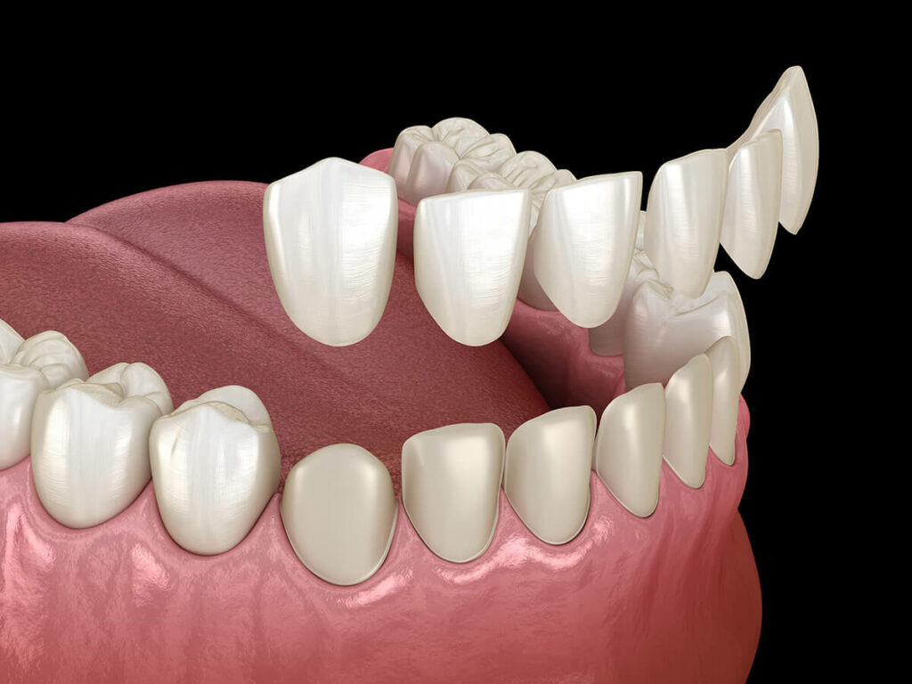 3D illustration of a set of lower teeth with dental veneers on the front six teeth, showcasing a cosmetic dentistry procedure for smile enhancement on a dark background.